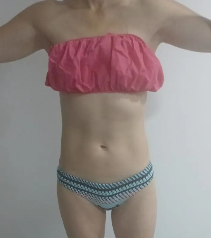 Abdomen antes del tratamiento de marcación abdominal con M-Sculp en Bogotá