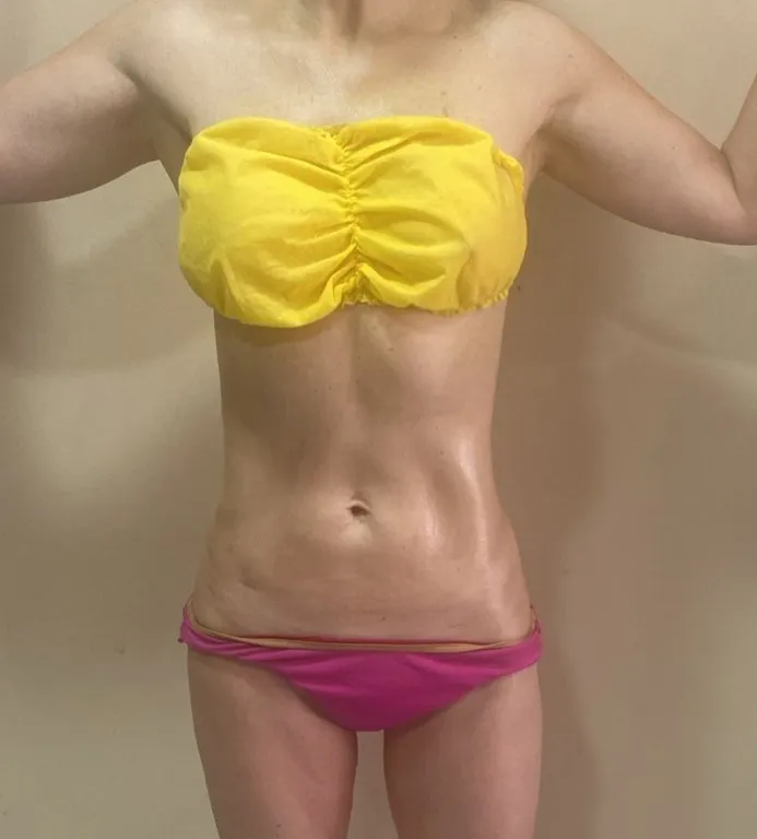 Resultado de marcación abdominal con M-Sculp en Bogotá — después del tratamiento