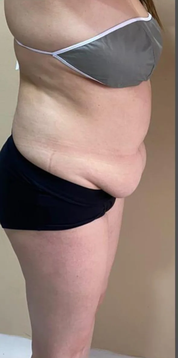 Abdomen antes de iniciar el tratamiento corporal reductor en Bogotá