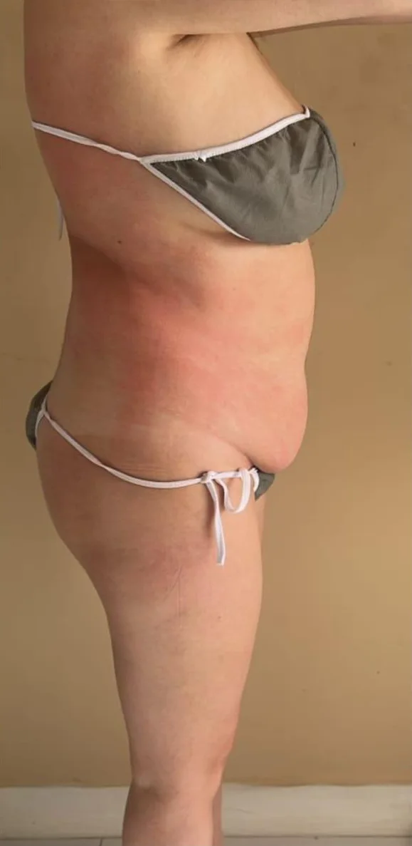 Reducción de abdomen tras cuatro sesiones de tratamiento corporal en Bogotá — después