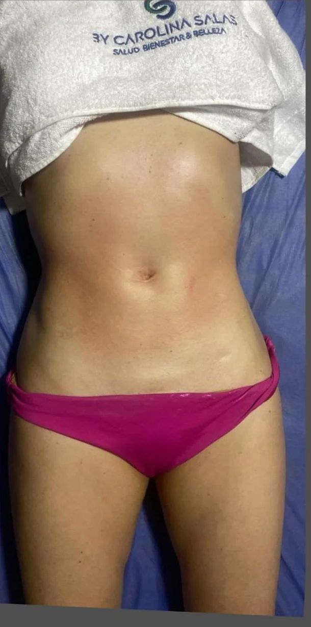 Abdomen antes del tratamiento de reducción de grasa localizada en Bogotá