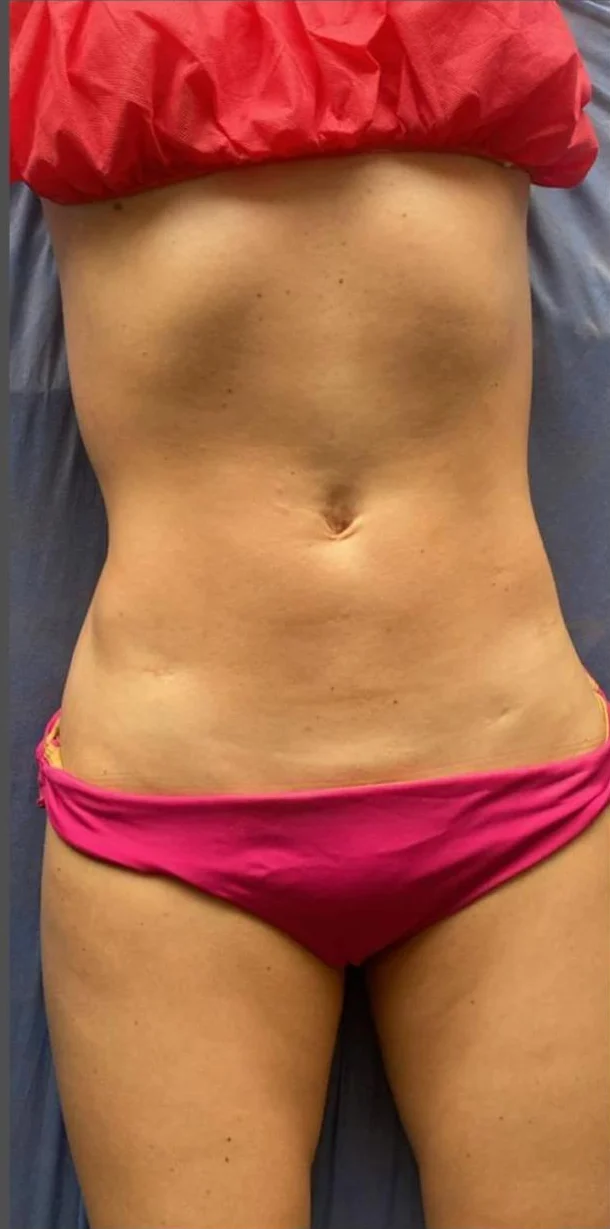 Reducción de grasa abdominal localizada con tecnología corporal en Bogotá — después