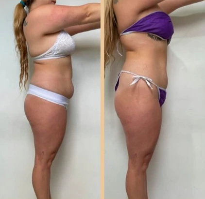 Reducción de abdomen vista lateral en Bogotá — antes y después