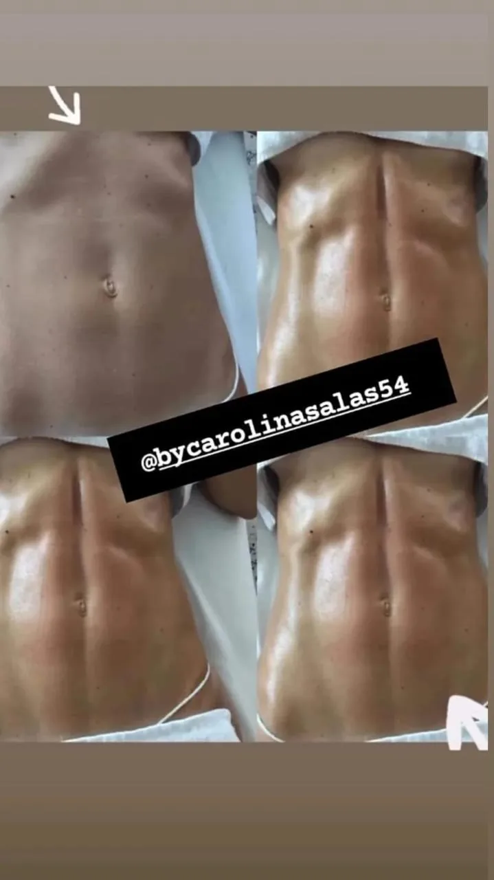 Resultados de marcación abdominal con M-Sculp en Bogotá, progreso por sesiones