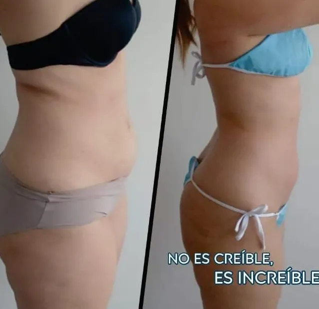 Resultado tras la cuarta sesión de tratamiento reductor en Bogotá — antes y después