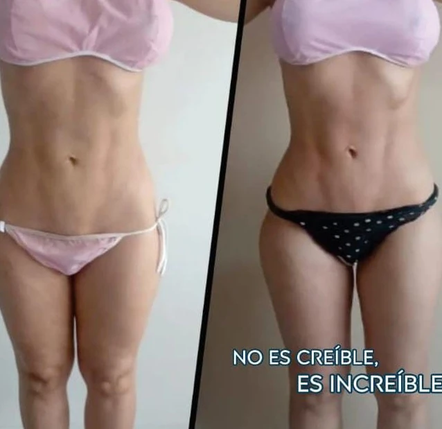 Reducción de abdomen con tratamiento corporal no invasivo en Bogotá — antes y después