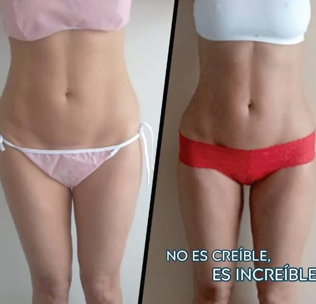 Reducción de grasa abdominal en Bogotá — comparación antes y después