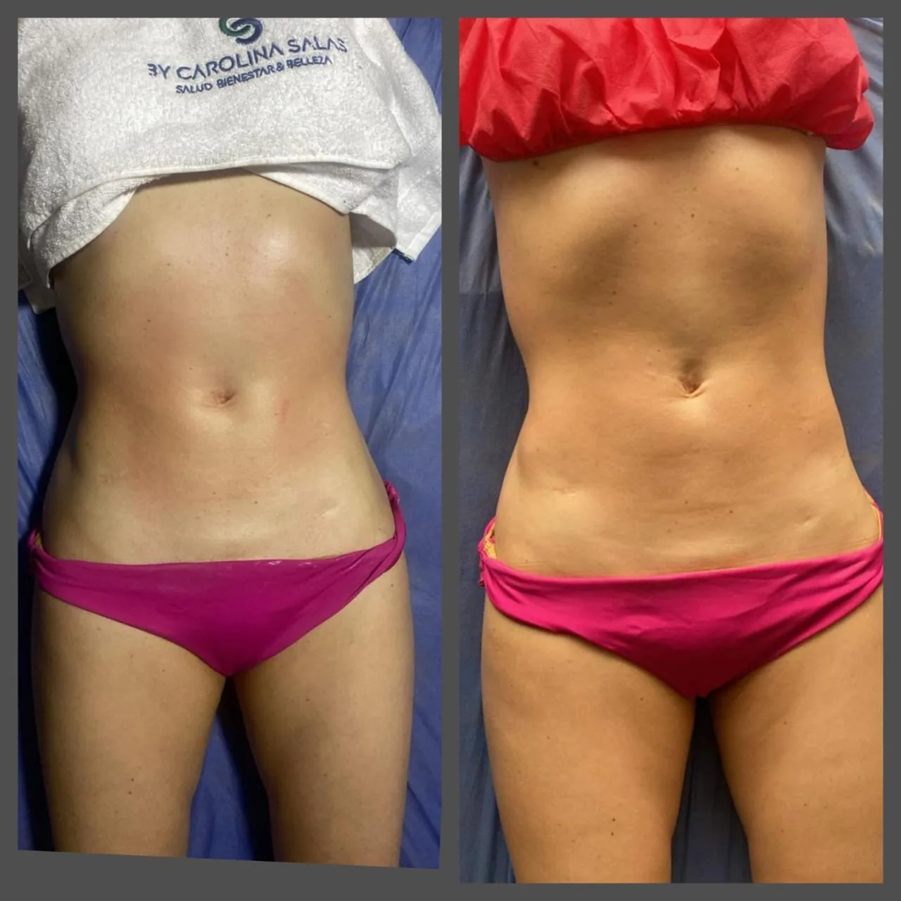 Abdomen plano tras tratamiento corporal no invasivo en Bogotá — antes y después