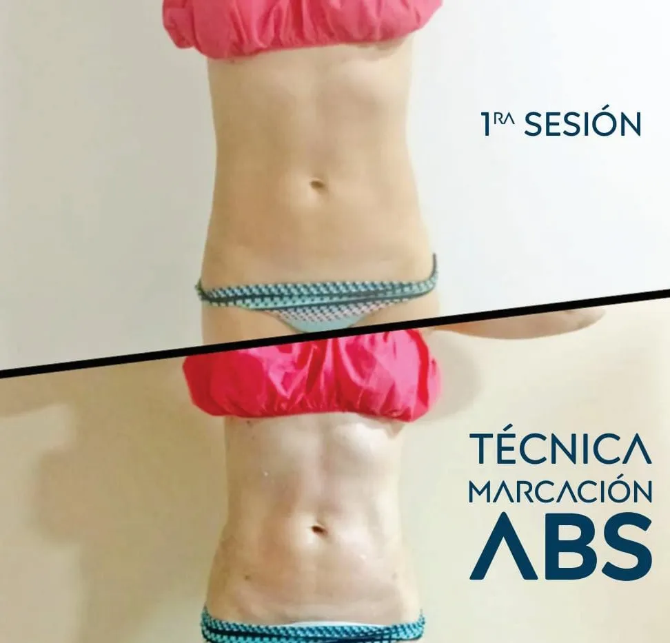 Marcación abdominal con M-Sculp en Bogotá — resultado real