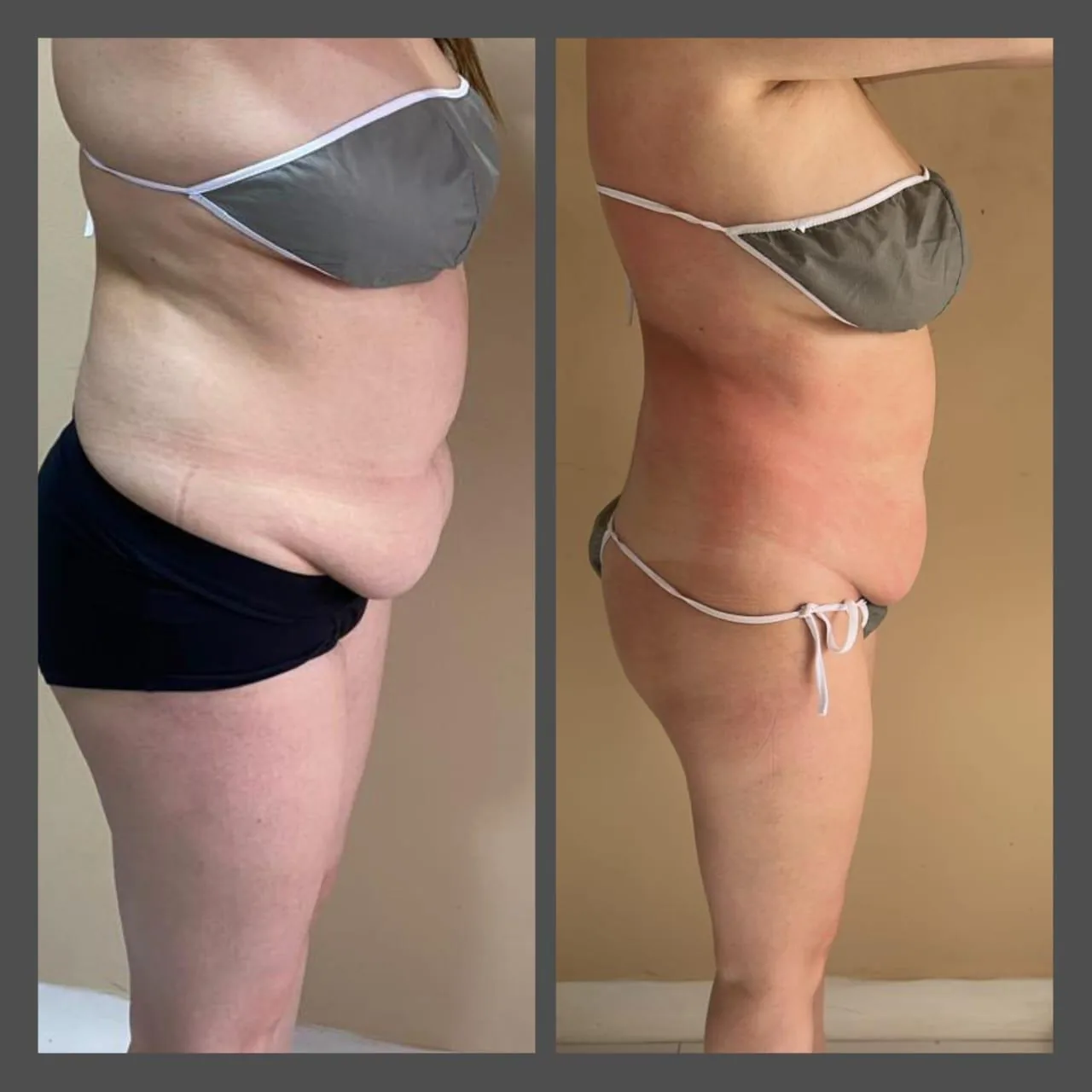 Reducción de abdomen vista de perfil en Bogotá — antes y después del tratamiento